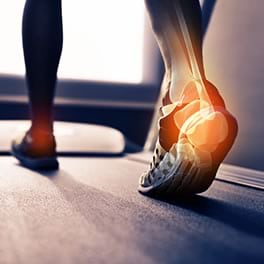 Plantar Fasciitis